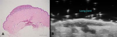 Usefulness of High-Frequency Ultrasonography in the Diagnosis of Melanoma: Mini Review